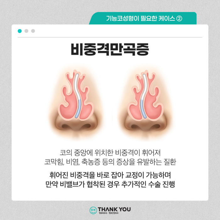 기능코수술병원에서 콧 속 불편함, 외적 스트레스 동시 해소! 관련 이미지 6