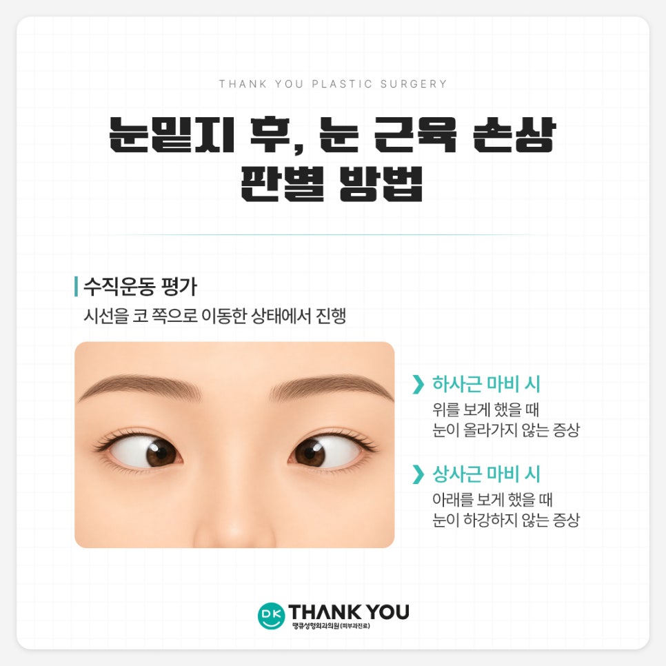 눈밑지방재배치 사시?! 눈밑지 사시는 왜 생길까 관련 이미지 5