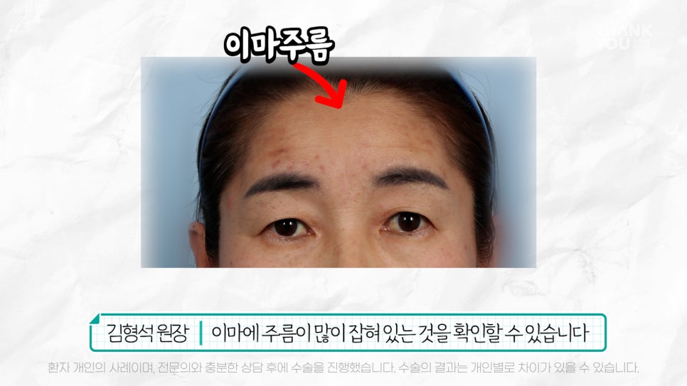 중년눈성형 전후& 이마거상+눈썹하거상+쌍수로 젊어지기 관련 이미지 16