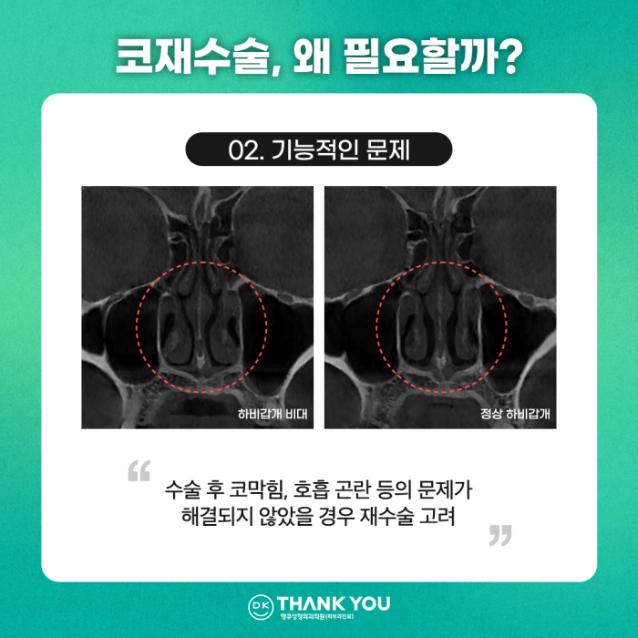 코재수술잘하는곳, 신중하게 선택해야 하는 이유는? 관련 이미지 4