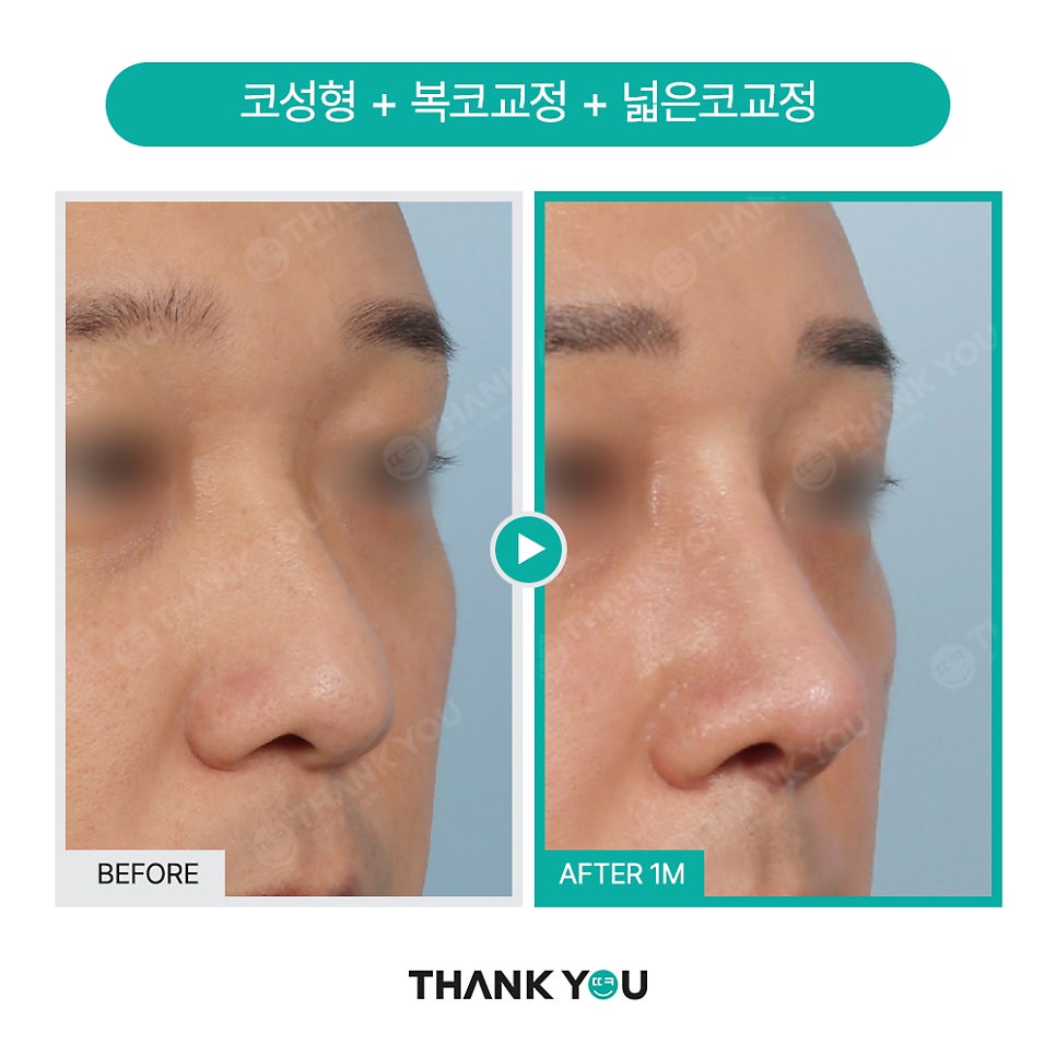 남자코성형 (휜코, 매부리코 등) 기능코성형 필요! [ft.코수술전후] 관련 이미지 4