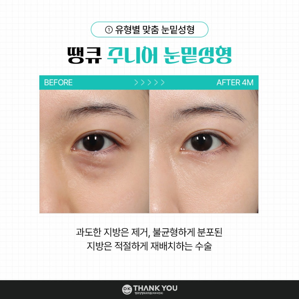 눈밑성형, 연령별로 달라지는 수술법! 무엇이 다를까? 관련 이미지 3