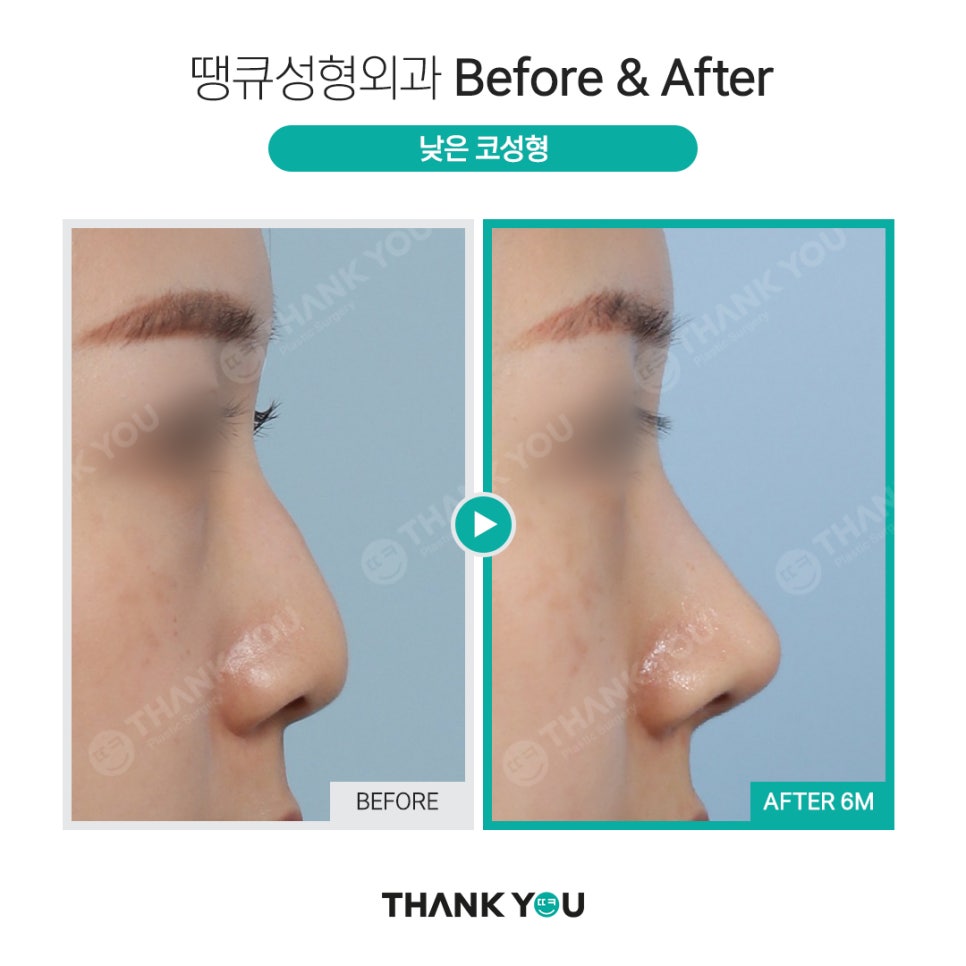 강남 코성형 전후, 코수술 잘하는 곳? 관련 이미지 11