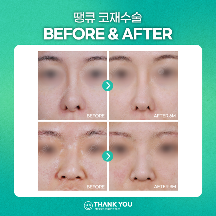 코재수술잘하는곳, 신중하게 선택해야 하는 이유는? 관련 이미지 11