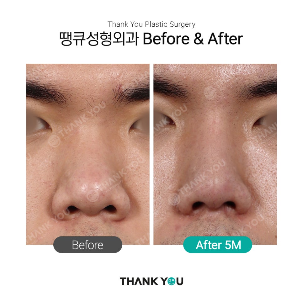 남자코성형 여자코성형 디자인 차이점 (코성형 전후) 관련 이미지 3