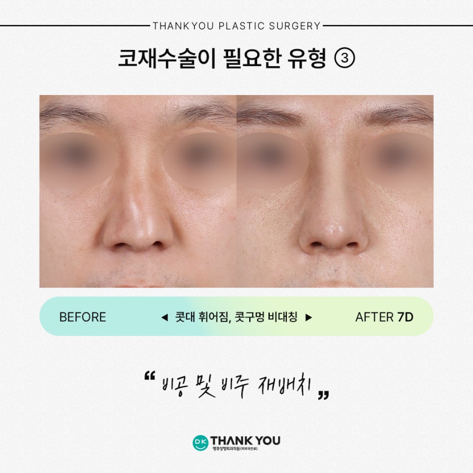 코재수술잘하는곳 땡큐가 제안하는 유형별 수술 방법은? 관련 이미지 5