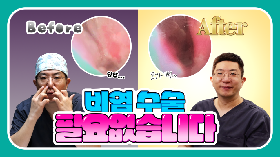 2분만에 막힌 코 뻥 뚫어주는 코블레이션 [ft.비염코성형 전후] 관련 이미지 1