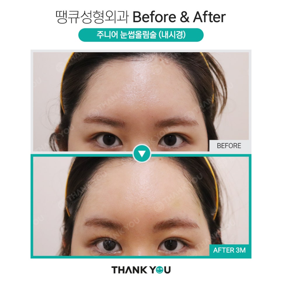 나이가 어린데도 이마거상을 꼭 해야 할까요? 관련 이미지 5