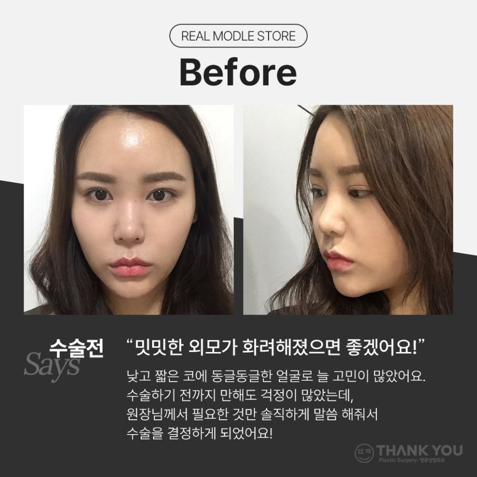 코필러 대신 여자코성형 (콧대+코끝)자연스럽게 관련 이미지 2