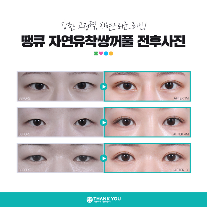 자연유착쌍커풀 수술로 타고난 듯 아름다운 눈 만들기🍀 관련 이미지 6