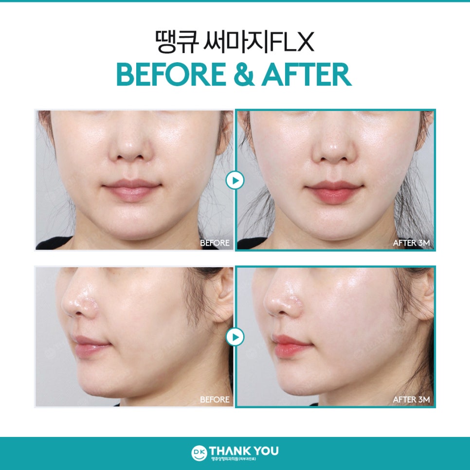 써마지잘하는곳 찾고 있다면? 땡큐 써마지 FLX로 주름&middot;탄력 관리하기! 관련 이미지 10