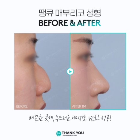 Hump Nose Improvement: Personalized Surgery Is Important! image 10