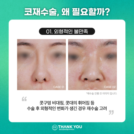 코재수술잘하는곳, 신중하게 선택해야 하는 이유는? 관련 이미지 3