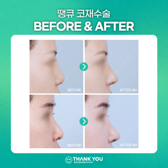 코재수술잘하는곳, 신중하게 선택해야 하는 이유는? 관련 이미지 10