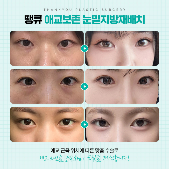 광일병 in 땡큐성형외과 ✨ 눈밑지 & 다크서클 편 공개 관련 이미지 5
