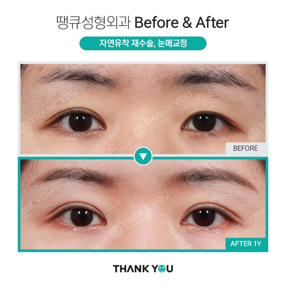 눈매교정 전후? 수술 전후사진으로 체크해요 관련 이미지 5