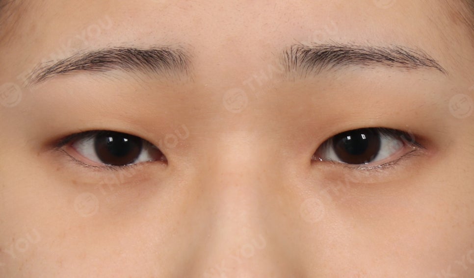 눈밑지방재배치 앞광대 지방이식이 필요한 이유? 관련 이미지 3