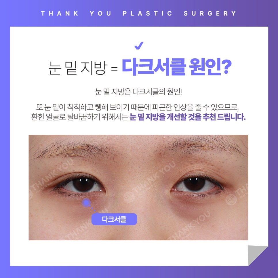 눈밑 불룩? 눈밑지방재배치 수술 후에도 재발할까? 관련 이미지 3