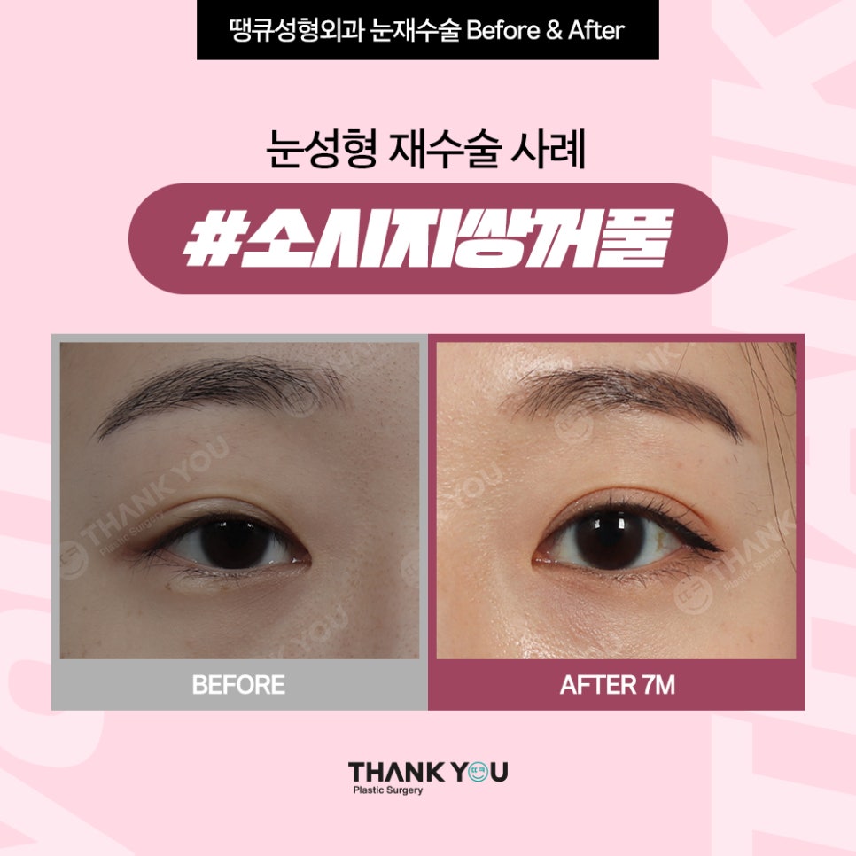짝눈 교정, 쌍수 재수술 시기 알려드려요 관련 이미지 6