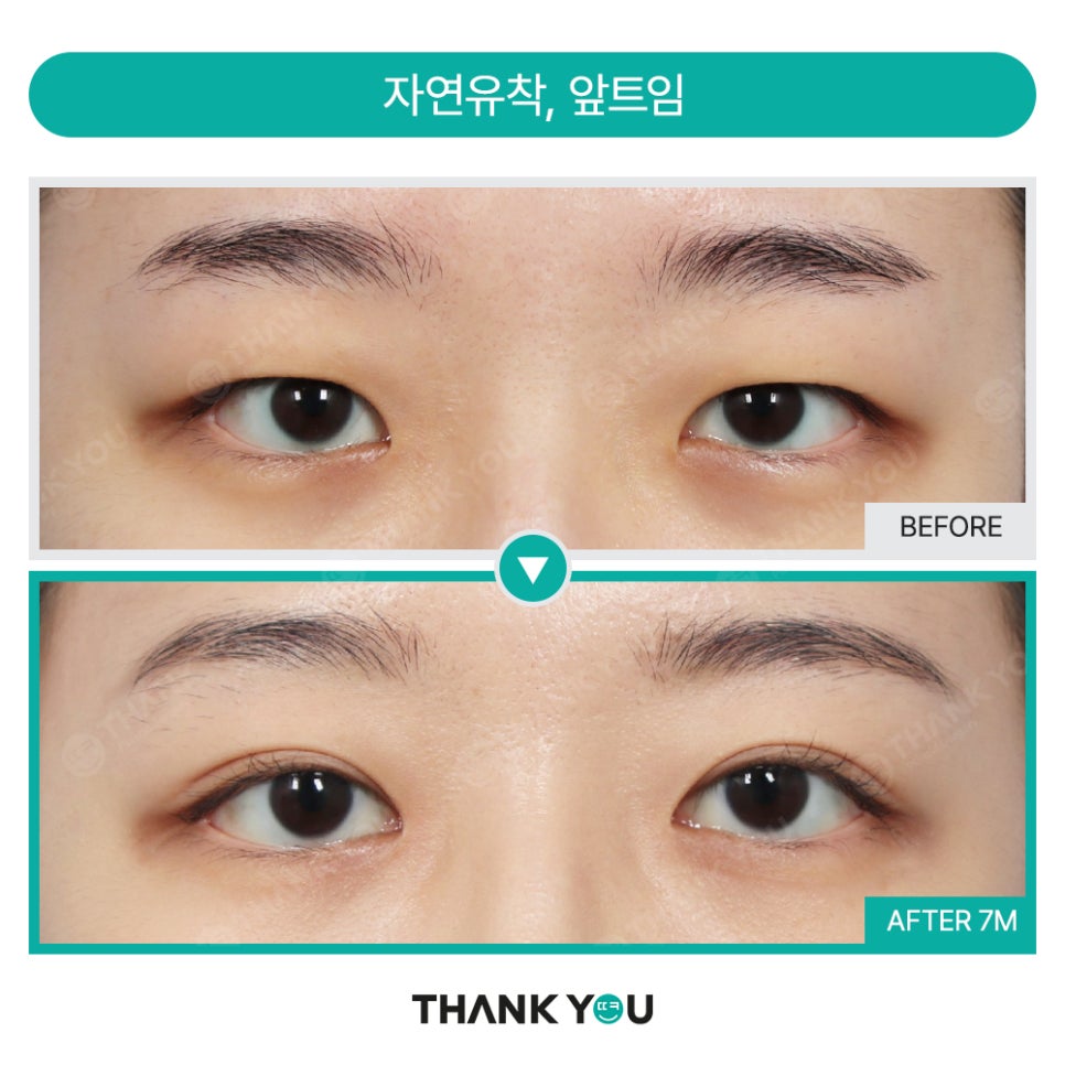 [비절개눈매교정+앞윗트임+눈밑지] 자고 일어났을 뿐인데 제니가?! 관련 이미지 17