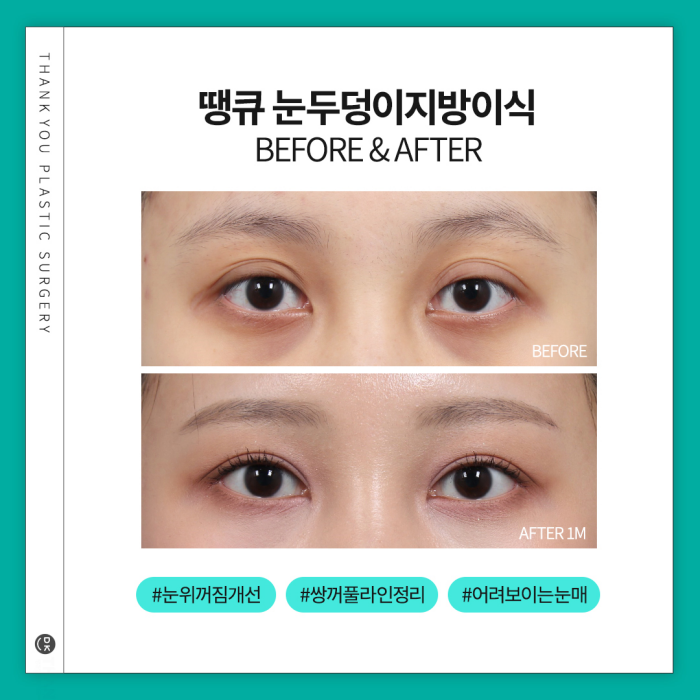 눈두덩이지방이식으로 피곤한 이미지 탈출! 생기있는 눈매 완성! 관련 이미지 5