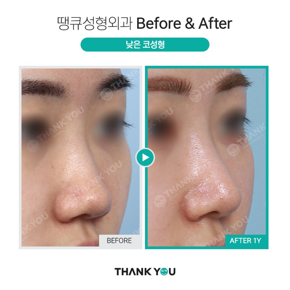 코성형 실리콘 비침, 코낮추기 재수술로 매끈하게 관련 이미지 20