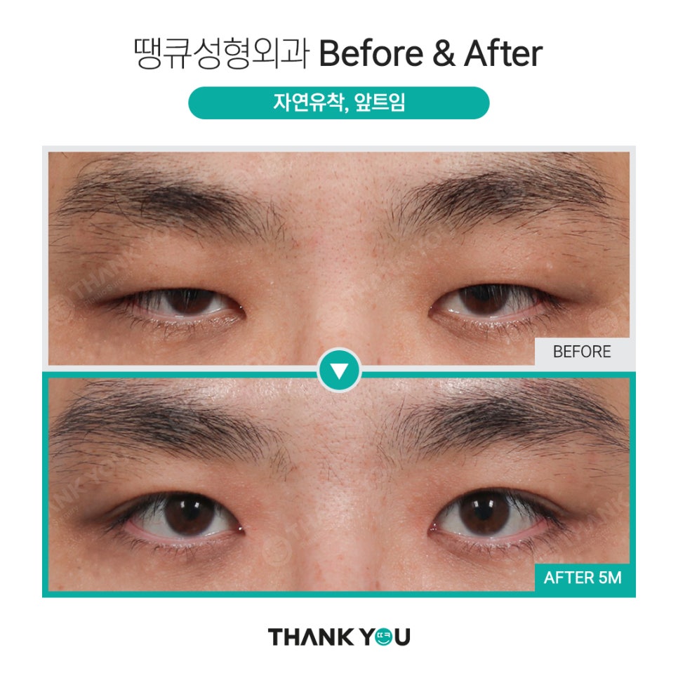 남자 쌍수 전후, 관련 이미지 4