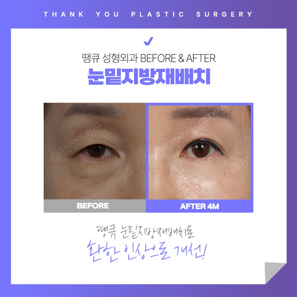 눈밑 불룩? 눈밑지방재배치 수술 후에도 재발할까? 관련 이미지 11