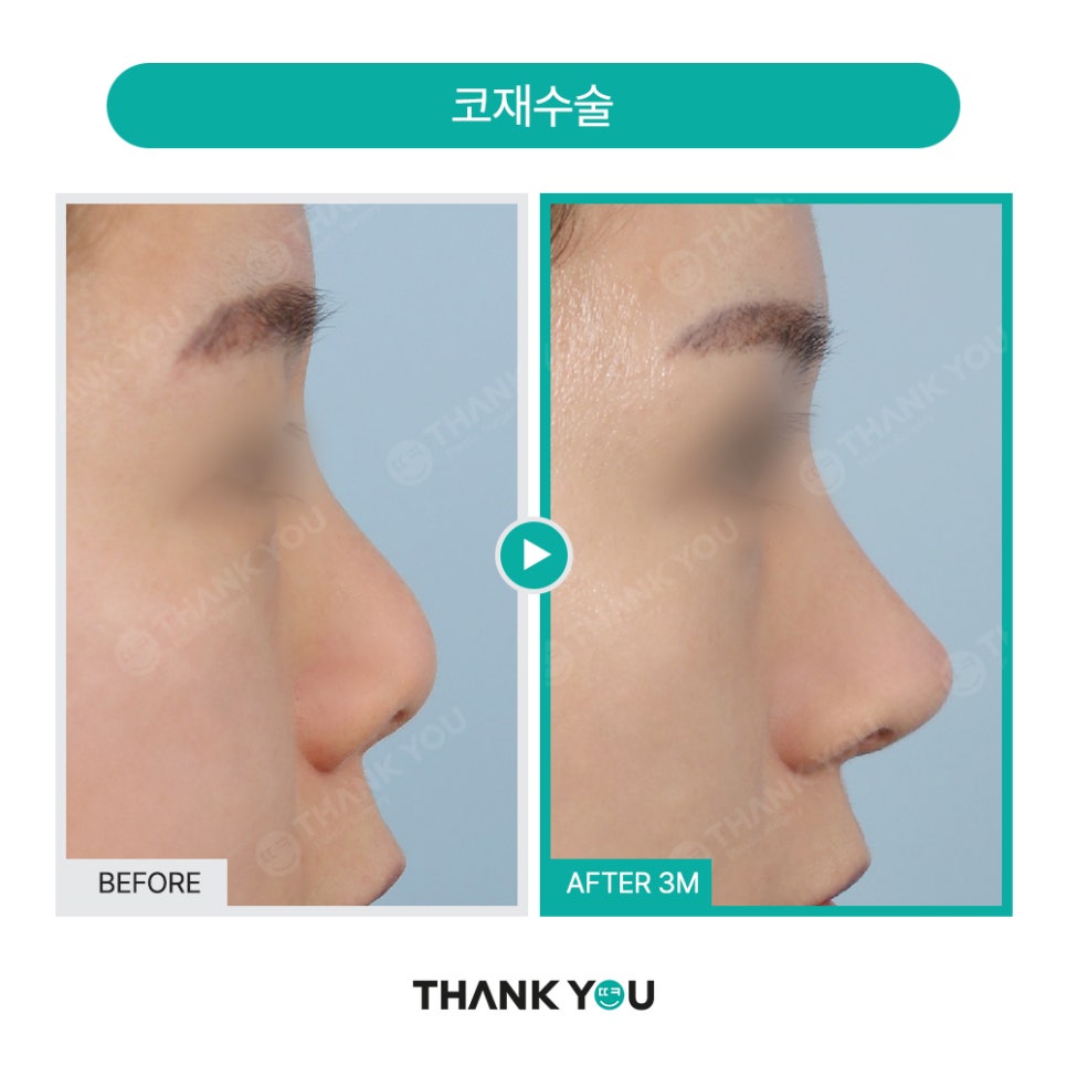코성형 실리콘 비침, 코낮추기 재수술로 매끈하게 관련 이미지 19