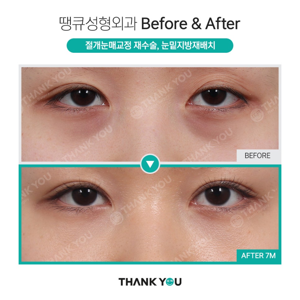 하안검과 눈밑지방재배치의 차이점? 관련 이미지 14