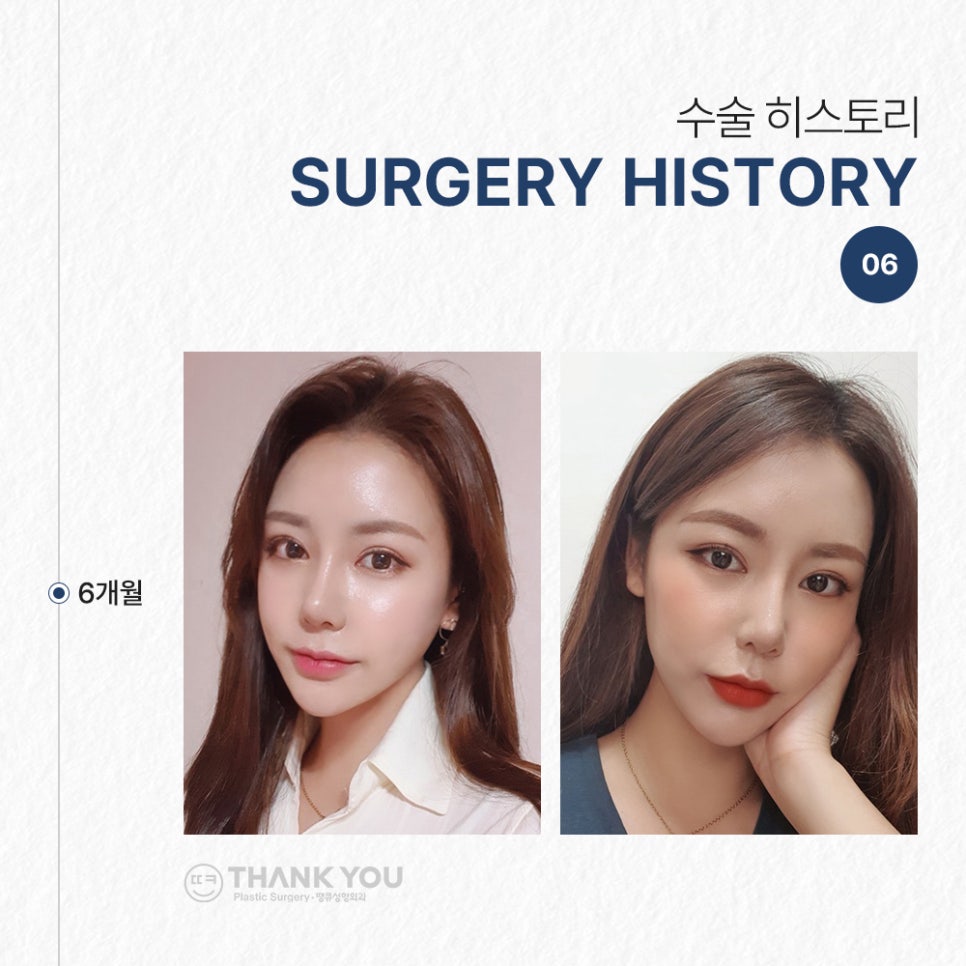 코필러 대신 여자코성형 (콧대+코끝)자연스럽게 관련 이미지 9