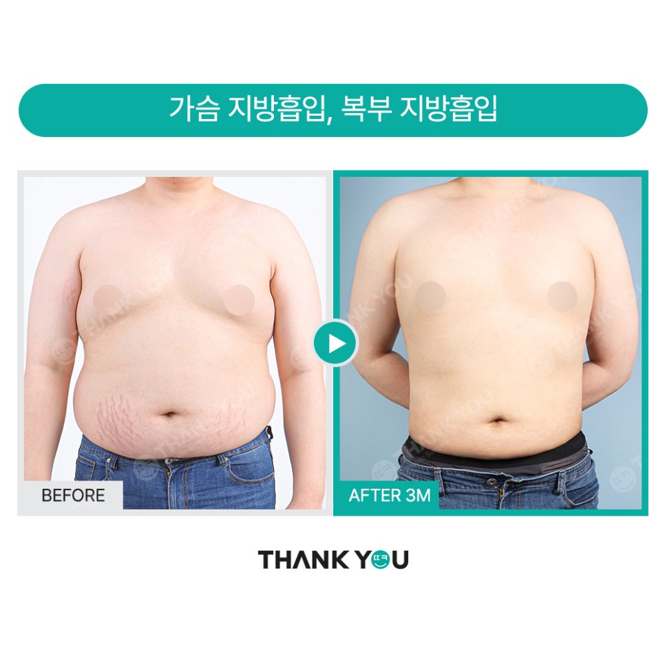 땡큐 맥미남, 뮤지컬배우 남자 복부지방흡입 전후 Check 관련 이미지 21