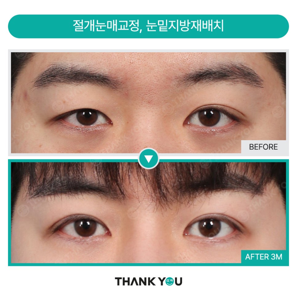 땡큐 맥미남, 뮤지컬배우 남자 복부지방흡입 전후 Check 관련 이미지 9