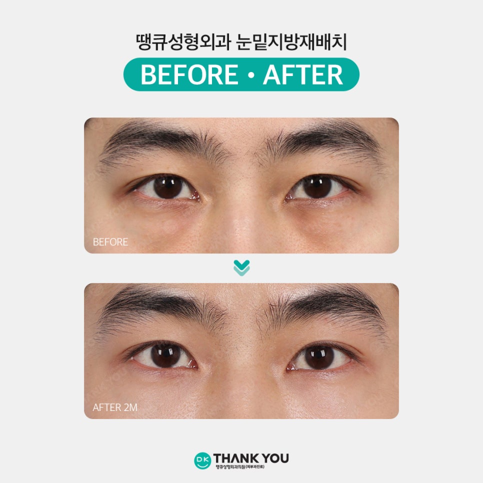 Under-Eye Fat Repositioning Side Effects: What Are the Causes and Treatment Methods?! image 7