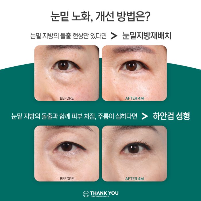If You Want a Satisfying Difference Before and After Lower Blepharoplasty?! Thank You Dual Lower Blepharoplasty image 3