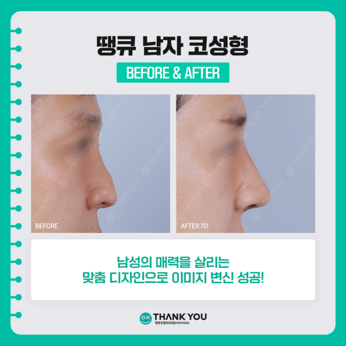 A Successful Image Transformation at Thank You, a Great Place for Male Rhinoplasty! image 8