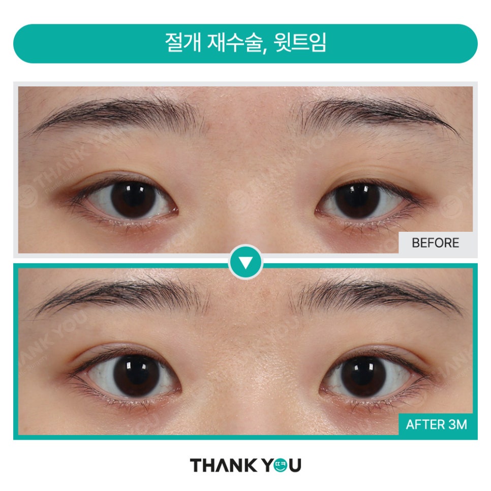 눈재수술 실패하지 않으려면? 눈 재수술유형&전후 체크 관련 이미지 7