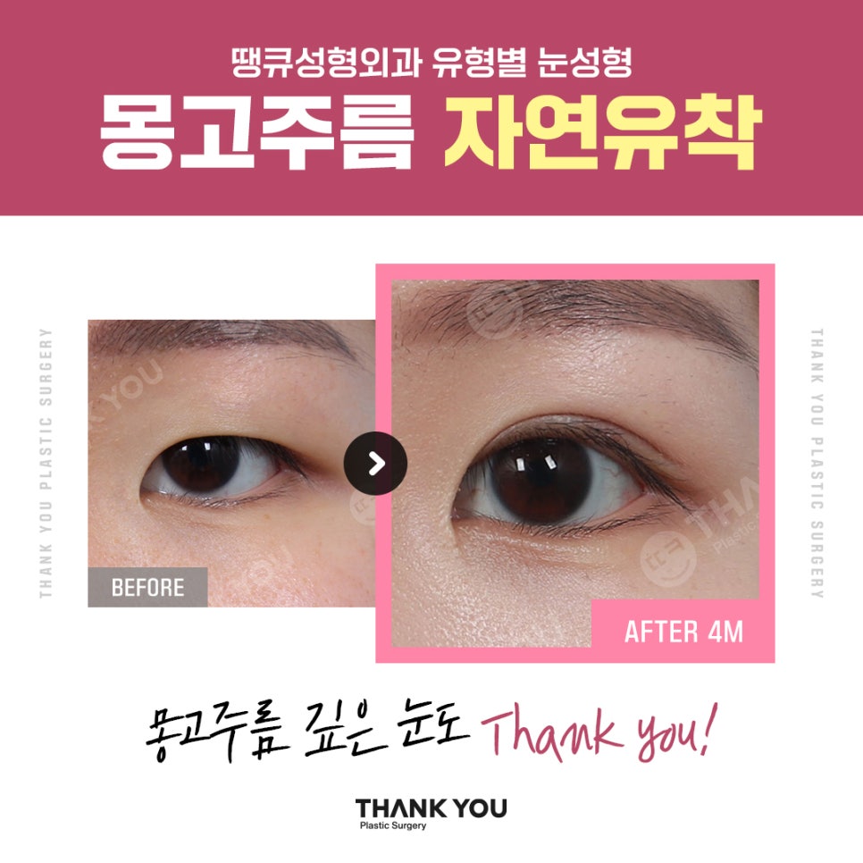 신논현역 성형외과에서 쌍수 전후 Check✨ 관련 이미지 9