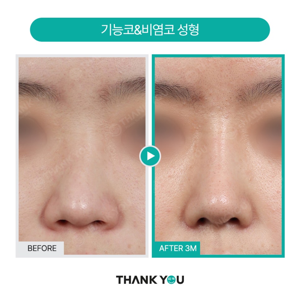 2분만에 막힌 코 뻥 뚫어주는 코블레이션 [ft.비염코성형 전후] 관련 이미지 23