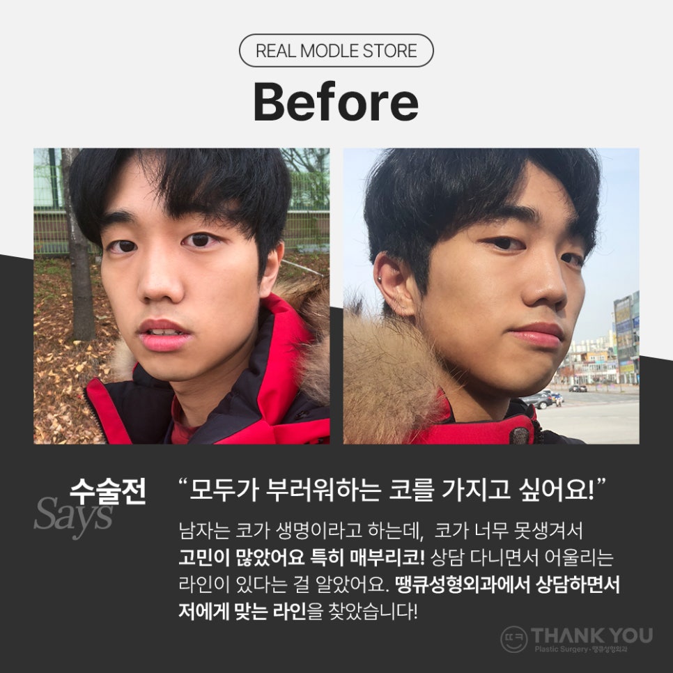 남자코성형후기, 코절골술로 매부리코를 매끈하게 관련 이미지 2