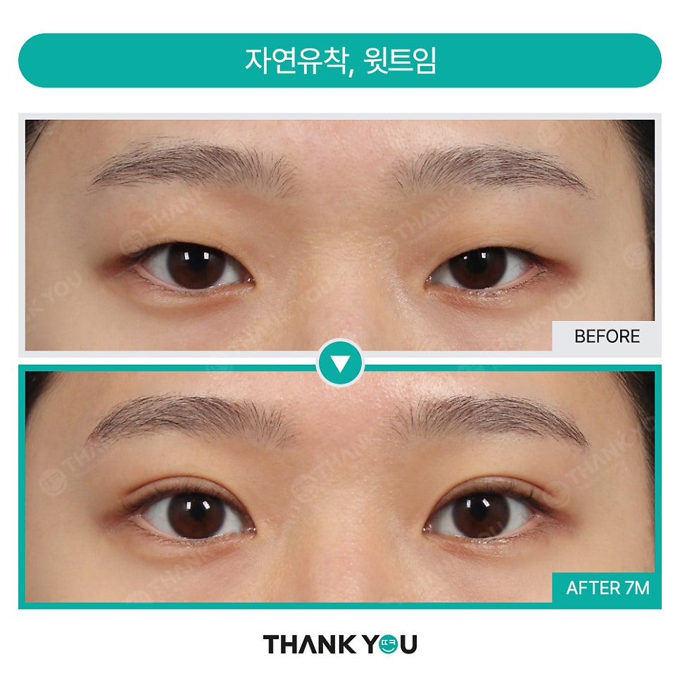[비절개눈매교정+앞윗트임+눈밑지] 자고 일어났을 뿐인데 제니가?! 관련 이미지 21