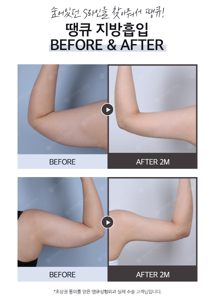 Difference Before and After Liposuction? See the Results with Thank You 1-Point Liposuction! image 7