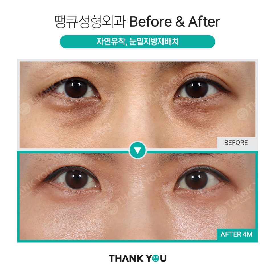 눈밑지 지방이식? 앞광대지방이식 필요한 이유? 관련 이미지 9