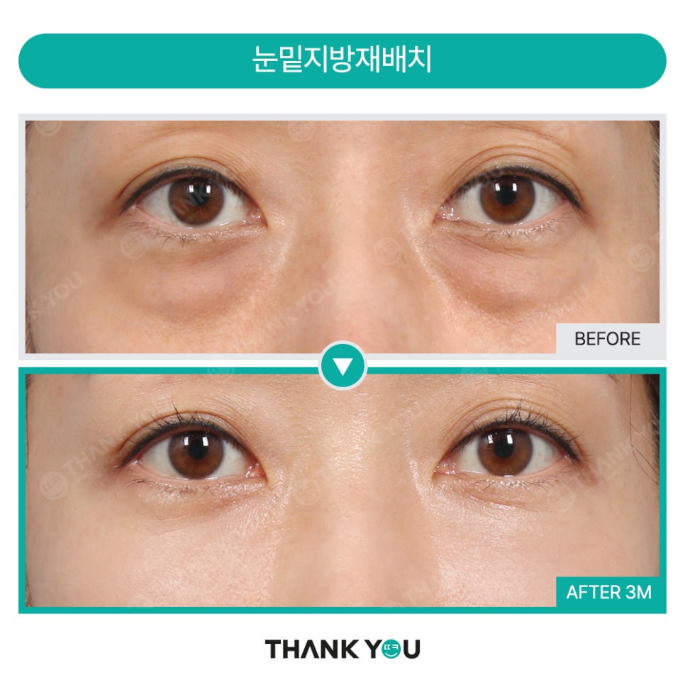 눈밑 수술, 혈류 보존이란? 관련 이미지 10