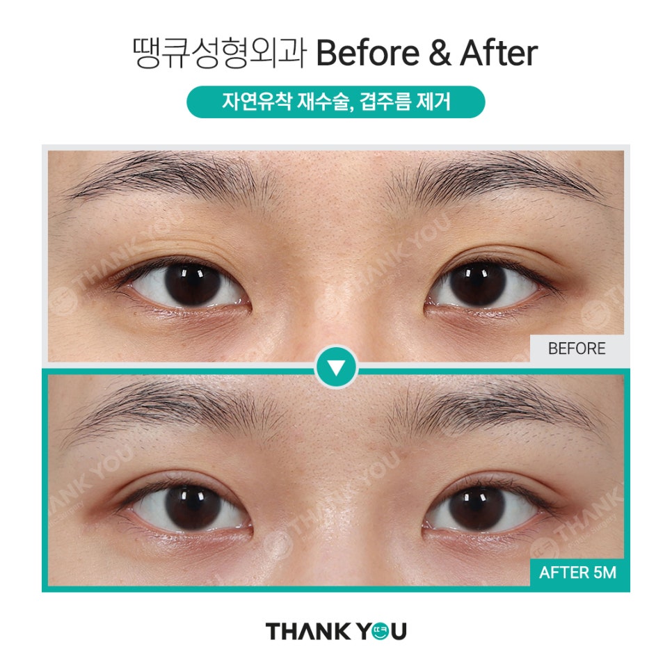 쌍수 풀기 (재수술전 실풀기+ 눈재수술 전후) 관련 이미지 12