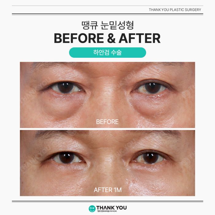 Lower Blepharoplasty and Under-Eye Fat Repositioning: What’s the Difference? image 4