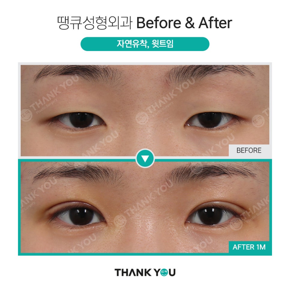 남자 쌍수 전후, 관련 이미지 3