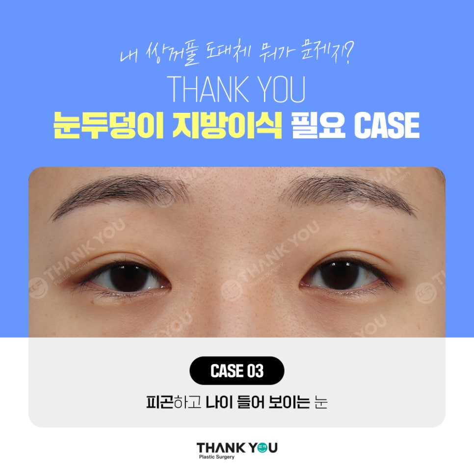 눈두덩이 지방이식, 푹꺼진 눈꺼풀에 자가지방이식으로 관련 이미지 7