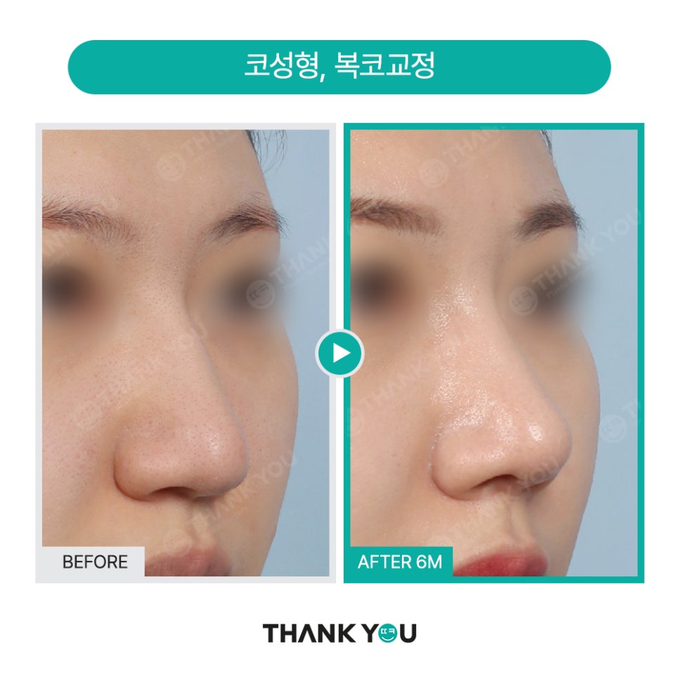 코성형, 비공내리기 수술이란? [콧구멍 잘 보이는 용코 개선] 관련 이미지 5