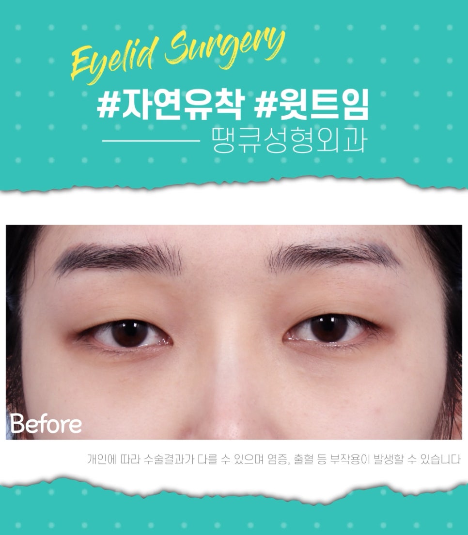 쌍수 윗트임 전후, 내게 맞춘 쌍트 수술로 화려하게 관련 이미지 1